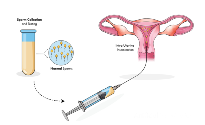 Intra-uterine Insemination (IUI)