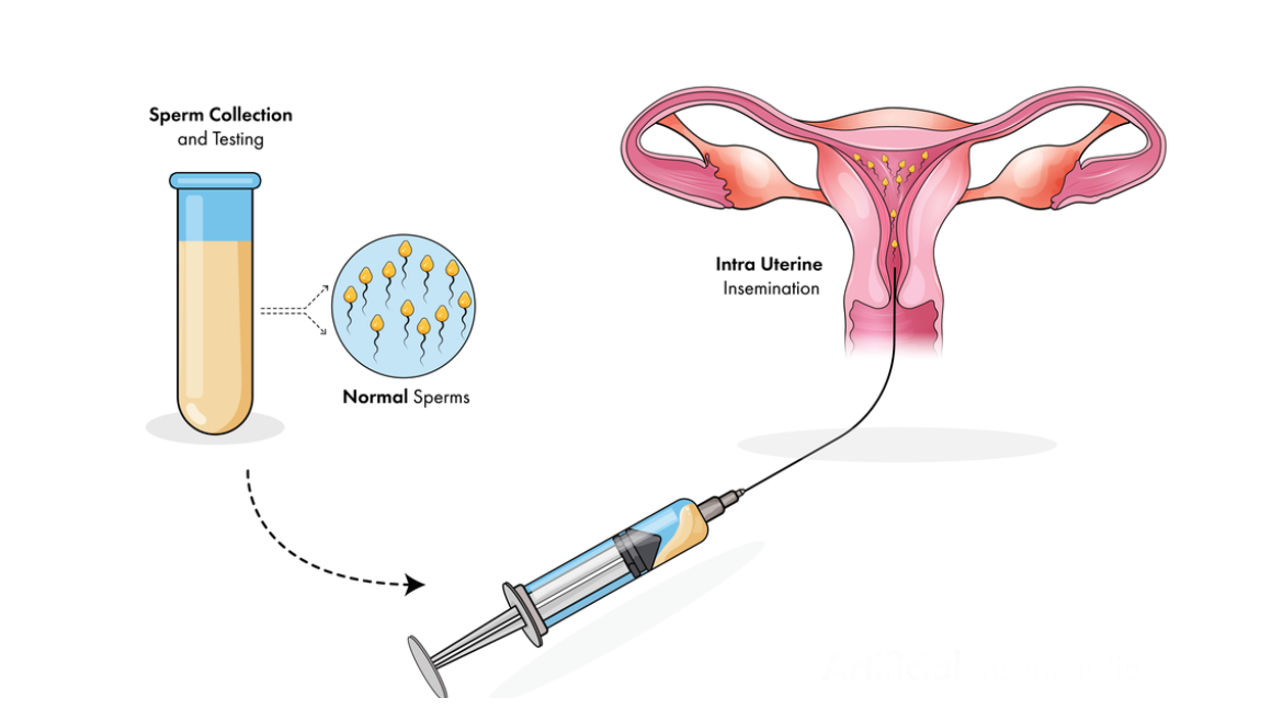 Intra-uterine Insemination <br>(IUI)