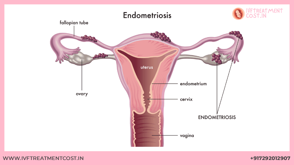 Endometriosis and IVF Treatment: Complete Guide to Fertility Success